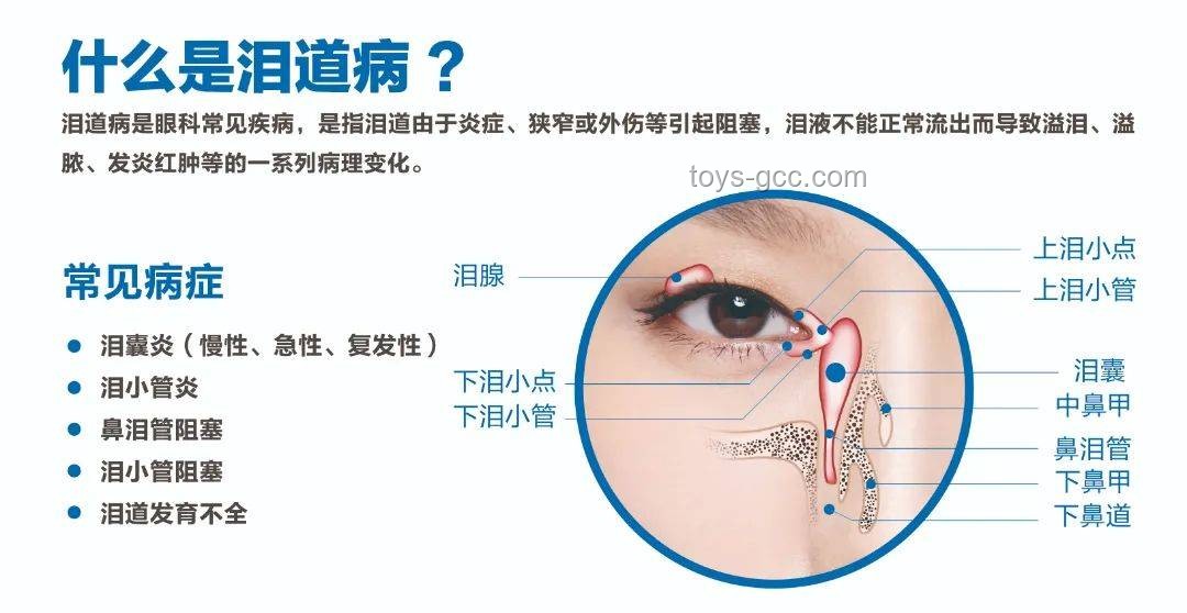 **泪囊异常症状对比：女子右眼狂飙泪与常见泪道疾病**